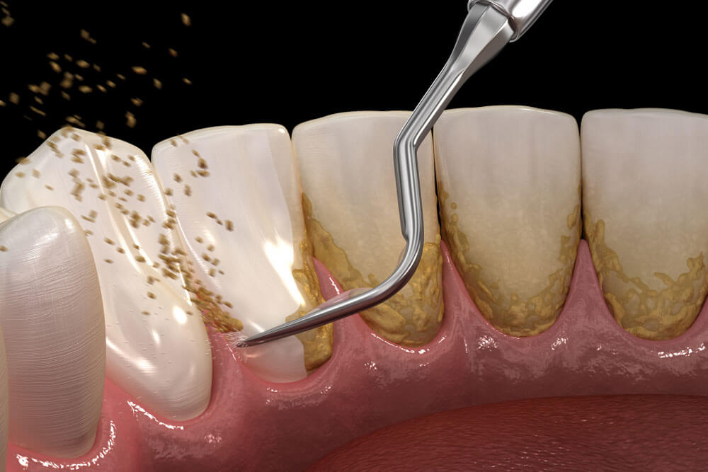 Dental Cleaning & Consultation Wolfeboro, NH Back Bay Dental