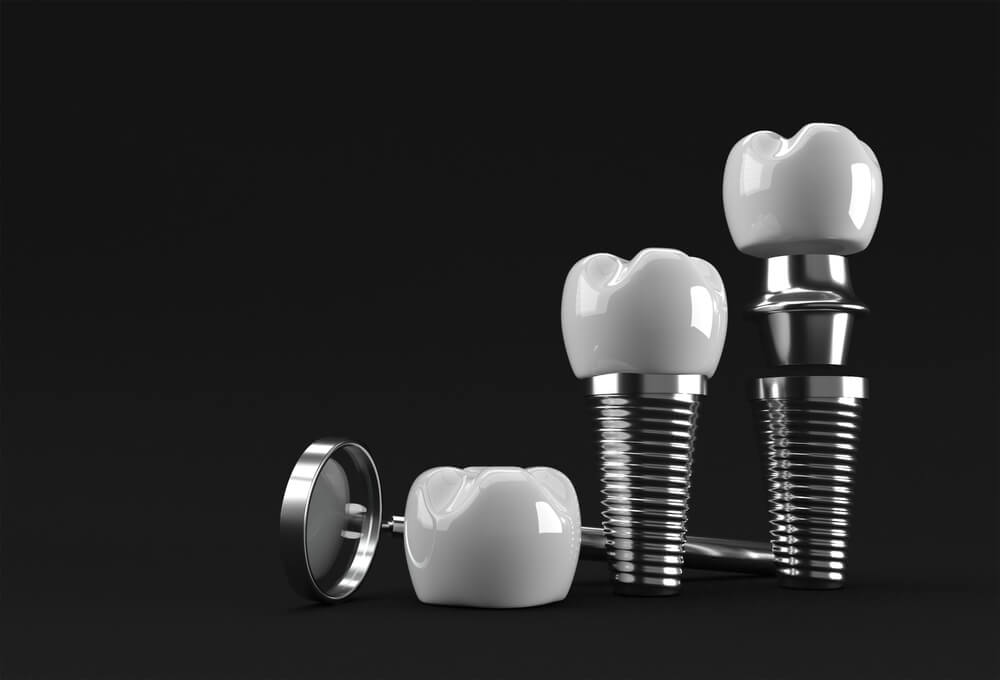 Dental Implants Wolfeboro, NH Back Bay Dental