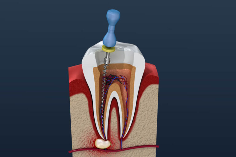 Root Canals Wolfeboro, NH Back Bay Dental